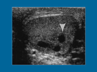 Intratesticular varicocele in a 38-year-old man.  (a) Transverse oblique US scan of left testis reveals multiple intratesticular anechoic cystic areas (arrowhead).  (b) Duplex Doppler US scan shows that venous flow in these cystic areas increases during a Valsalva maneuver (arrowhead). 