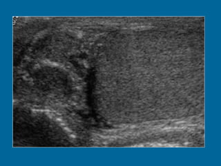 Image 1 (Ultrasound): Swelling of the right epididymis with associated mild right orchitis. Doppler images (not shown here) demonstrated increased vascularity. 