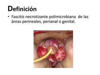 Definición
• Fascitis necrotizante polimicrobiana de las
  áreas perineales, perianal o genital.
 