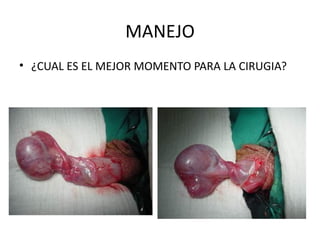MANEJO ¿CUAL ES EL MEJOR MOMENTO PARA LA CIRUGIA? 