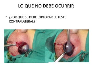 LO QUE NO DEBE OCURRIR ¿POR QUE SE DEBE EXPLORAR EL TESTE CONTRALATERAL? 