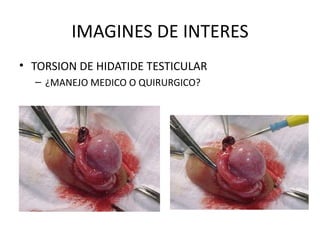 IMAGINES DE INTERES TORSION DE HIDATIDE TESTICULAR ¿MANEJO MEDICO O QUIRURGICO? 