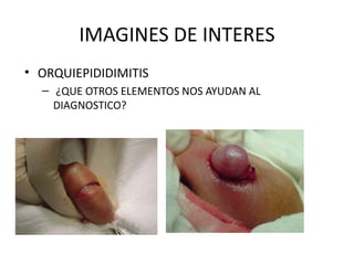 IMAGINES DE INTERES ORQUIEPIDIDIMITIS ¿QUE OTROS ELEMENTOS NOS AYUDAN AL DIAGNOSTICO? 