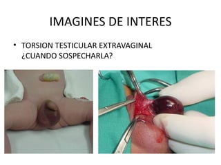 IMAGINES DE INTERES TORSION TESTICULAR EXTRAVAGINAL ¿CUANDO SOSPECHARLA? 