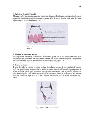 14



4. Sulcos de desenvolvimento
São depressões lineares, paralelas ao longo eixo do dente, localizadas nas faces vestibulares
de dentes anteriores, dividindo-as em segmentos. Têm desenvolvimento variável e são mais
freqüentes em dentes jovens (fig. 1.6.2).




                  Fig. 1.6.2
                  Dente 21



5. Lóbulos de desenvolvimento
São segmentos das faces vestibulares, delimitados pelos sulcos de desenvolvimento. Em
número de três, tendem a ser melhor visualizados em dentes reém irrompidos, chegando a
entalhar as bordas incisais, formando os mamelos incisais (figura 1.6.2).

6. Crista mediana
É uma elevação de esmalte presente na face lingual dos caninos. O terço incisal do canino
pode ser considerado uma cúspide, e assim, a aresta transversal lingual correspondente à
crista mediana, que é mais volumosa junta a ponta da cúspide e vai perdendo volume em
direção ao cíngulo. Pode apresentar-se também como uma elevação mais suave nos incisos
centrais e laterais superiores e é praticamente inexistente nos incisivos inferiores (fig.
1.6.3).




                               Fig. 1.6.3 Crista Mediana. Dente 23
 