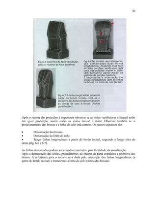 36




Após o recorte das projeções é importante observar se as vistas vestibulares e lingual estão
em igual proporção, assim como as vistas mesial e distal. Observar também se o
posicionamento das bossas e a linha de colo está correto. Os passos seguintes são:

•         Demarcação das bossas.
•         Demarcação da linha do colo.
•         Traçar linhas longitudinais a partir do bordo incisal, seguindo o longo eixo do
dente (fig. 6.6 e 6.7).

As linhas demarcadas podem ser avivadas com talco, para facilidade da visualização.
Após a demarcação das linhas, procederemos ao recorte da parte expulsiva e retentiva dos
dentes. A referência para o recorte será dada pela interseção das linhas longitudinais (a
partir do bordo incisal) e transversais (linha do colo e linha das bossas).
 