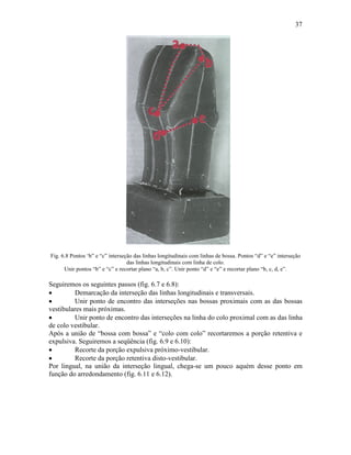 37




Fig. 6.8 Pontos ‘b” e “c” interseção das linhas longitudinais com linhas de bossa. Pontos “d” e “e” interseção
                                  das linhas longitudinais com linha de colo.
      Unir pontos “b” e “c” e recortar plano “a, b, c”. Unir ponto “d” e “e” e recortar plano “b, c, d, e”.

Seguiremos os seguintes passos (fig. 6.7 e 6.8):
•         Demarcação da interseção das linhas longitudinais e transversais.
•         Unir ponto de encontro das interseções nas bossas proximais com as das bossas
vestibulares mais próximas.
•         Unir ponto de encontro das interseções na linha do colo proximal com as das linha
de colo vestibular.
Após a união de “bossa com bossa” e “colo com colo” recortaremos a porção retentiva e
expulsiva. Seguiremos a seqüência (fig. 6.9 e 6.10):
•         Recorte da porção expulsiva próximo-vestibular.
•         Recorte da porção retentiva disto-vestibular.
Por lingual, na união da interseção lingual, chega-se um pouco aquém desse ponto em
função do arredondamento (fig. 6.11 e 6.12).
 