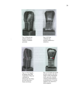 38




    Fig. 6.9 Recorte da      Fig. 6.10 Vista
.   porção expulsiva e       vestibular dos
    retentiva vestíbulo-     recortes expulsivos e
    proximal.                retentivos.




    Fig. 6.11 Por lingual,   Fig. 6.12 O limite do recorte
    há apenas uma linha      da parte retentiva não deve
    longitudinal. Observar   chegar à linha longitudinal
    a posição da             (seta), para não se perder
    demarcação das linhas    volume do dente durante o
    de colo com colo e       arredondamento. O recorte
    bossa com bossa.         expulsivo nos incisivos é
                             muito pequeno.
 