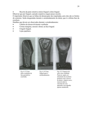 39


•         Recorte da parte retentiva mésio-lingual e disto-lingual.
Observar que por lingual, a porção expulsiva requer pouco recorte.
É importante observar que as linhas de demarcação são respeitadas, pois elas são os limites
do contorno. Serão desgastadas durante o arredondamento do dente, que é a última fase da
escultura.
Detalhes que devem ser observados durante o arredondamento:
•         Lóbulos de desenvolvimento vestibular.
•         Cristas marginai, mesial e distal, na face lingual.
•         Cíngulo lingual.
•         Lojas papilares.




          Fig. 6.13 Vista           Fig. 6.14 Vista         Fig. 6.15 Aspecto de
          disto-vestibular da       lingual após o          uma vista vestibular.
          fase geométrica           arredondamento.         Passa-se, agora, ao
          concluída.                                        alisamento da escultura
                                                            primeiro com a escova
                                                            de dente e, depois com a
                                                            meia de seda ou
                                                            solventes de cera
                                                            aplicados com algodão
                                                            apenas umedecido.
 
