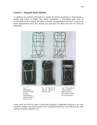 40


Capítulo 7 – Segundo molar inferior

A seqüência de escultura utilizando-se o auxílio do método geométrico é, basicamente, a
mesma para todos os dentes. Nos dentes posteriores, a dificuldade pode estar no
envolvimento da face oclusal. De todos os dentes, o segundo molar inferior é o que possui
maior geometrismo nessa face. Razão esta, para que este dente seja feito no início do
tratamento.




            Fig. 7.3                 Fig. 7.4 Recorte da       Fig. 7.5 Desenho da
            Demarcada a              projeção mesial no        vista vestibular
            posição da linha         bloco de cera.            aplicado sobre o
            do colo,                                           bloco após o recorte
            desenhamos a                                       da vista proximal.
            vista proximal no
            bloco de cera.


Assim como nos incisivos, após o recorte das projeções, é importante observar se as vistas
vestibular, lingual e proximais, assim como as posições das bossas e da linha de colo, estão
corretas. Os passos seguintes são:
 