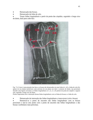 41


•        Demarcação das bossas.
•        Demarcação da linha de colo.
•        Traçar linhas longitudinais a partir da ponta das cúspides, seguindo o longo eixo
do dente, duas para cada face.




Fig. 7.6: Como é uma projeção das faces, as bossas são demarcadas em uma linha (a1, a2); a linha do colo (b),
apesar de nos dentes posteriores estar próximo de um plano em todo o contorno do dente, nas proximais
fazendo uma ligeira curvatura; as linhas longitudinais (c1, c2, c3, c4) partem da ponta de cúspide e seguem
reto, seguindo o longo eixo do dente.
Pontos importantes são a interseção dessas linhas longitudinais com as linhas de bossas e a linha do colo.

•        Demarcação da interseção das linhas longitudinais e transversais (colo e bossa).
•        Demarcar-se o ponto de encontro das linhas longitudinais com as bossas
proximais e une-se este ponto com o ponto de encontro das linhas longitudinais e das
bossas vestibulares mais próximas.
 