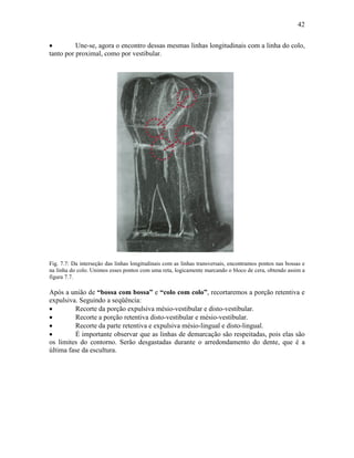 42


•         Une-se, agora o encontro dessas mesmas linhas longitudinais com a linha do colo,
tanto por proximal, como por vestibular.




Fig. 7.7: Da interseção das linhas longitudinais com as linhas transversais, encontramos pontos nas bossas e
na linha do colo. Unimos esses pontos com uma reta, logicamente marcando o bloco de cera, obtendo assim a
figura 7.7.

Após a união de “bossa com bossa” e “colo com colo”, recortaremos a porção retentiva e
expulsiva. Seguindo a seqüência:
•         Recorte da porção expulsiva mésio-vestibular e disto-vestibular.
•         Recorte a porção retentiva disto-vestibular e mésio-vestibular.
•         Recorte da parte retentiva e expulsiva mésio-lingual e disto-lingual.
•         É importante observar que as linhas de demarcação são respeitadas, pois elas são
os limites do contorno. Serão desgastadas durante o arredondamento do dente, que é a
última fase da escultura.
 