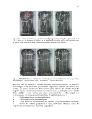 43




Fig. 7.8, 7.9 e 7.10: os pontos “a, b, c, d, e” formam uma figura geométrica com 3 planos, plano “a, b, c” “a,
e, d” e plano “e, c, d”. Unindo-se os pontos “a, b, d” obtemos um novo plano que é a parte expulsiva (acima
da linha de maior contorno) do dente. O mesmo procedimento obtém-se a parte retentiva.




Fig. 7.11, 7.12 e 7.13: O mesmo procedimento executado por próximo-vestibular é feito com relação as faces
próximo-linguais. Obtendo-se desta forma a parte retentiva e expulsiva dessas faces.

Após essa fase, nós obtemos as vertentes proximais externas das cúspides. Em uma visão
oclusal (figura 7.14), observamos que as arestas longitudinais estão em uma posição mais
externa à sua posição real do dente. Procederemos agora, o recorte das vertentes distais das
cúspides mesiais e as vertentes mesiais das cúspides distais. A definição dessas vertentes
define também a parte externa dos sulcos ocluso-vestibular e ocluso-lingual e o
posicionamento correto das arestas longitudinais. A seqüência do recorte é:
•         União das pontas de cúspides vestibulares.
•         União das pontas de cúspides linguais.
•         Traçar direção do sulco vestibular (até a metade o terço médio da face vestibular).
•         Recorte das vertentes que formam os sulcos, tendo como referencia a união das
cúspides (arestas longitudinais) e as linhas longitudinais.
 