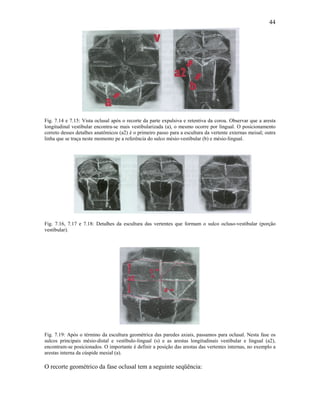 44




Fig. 7.14 e 7.15: Vista oclusal após o recorte da parte expulsiva e retentiva da coroa. Observar que a aresta
longitudinal vestibular encontra-se mais vestibularizada (a), o mesmo ocorre por lingual. O posicionamento
correto desses detalhes anatômicos (a2) é o primeiro passo para a escultura da vertente externas meisal; outra
linha que se traça neste momento pe a referência do sulco mésio-vestibular (b) e mésio-lingual.




Fig. 7.16, 7.17 e 7.18: Detalhes da escultura das vertentes que formam o sulco ocluso-vestibular (porção
vestibular).




Fig. 7.19: Após o término da escultura geométrica das paredes axiais, passamos para oclusal. Nesta fase os
sulcos principais mésio-distal e vestíbulo-lingual (s) e as arestas longitudinais vestibular e lingual (a2),
encontram-se posicionados. O importante é definir a posição das arestas das vertentes internas, no exemplo a
arestas interna da cúspide mesial (a).

O recorte geométrico da fase oclusal tem a seguinte seqüência:
 