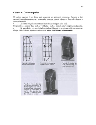 47


Capítulo 8 – Canino superior

O canino superior é um dente que apresenta um contorno volumoso. Durante a fase
geométrica cuidados devem ser observados para que o dente não perca dimensão durante o
arredondamento.
•        As linhas longitudinais são em número de uma para cada face.
No entanto, podem ser duas na face vestibular e na face lingual, uma bem próxima da outra.
•        Se a opção for por um linha longitudinal. Durante o recorte expulsivo e retentivo,
chegar com o recorte aquém do encontro de bossa com bossa e colo com colo.
 