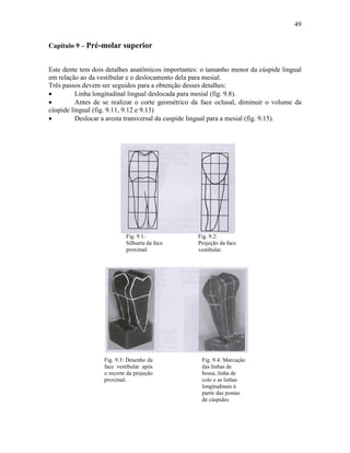 49


Capítulo 9 – Pré-molar superior


Este dente tem dois detalhes anatômicos importantes: o tamanho menor da cúspide lingual
em relação ao da vestibular e o deslocamento dela para mesial.
Três passos devem ser seguidos para a obtenção desses detalhes:
•         Linha longitudinal lingual deslocada para mesial (fig. 9.8).
•         Antes de se realizar o corte geométrico da face oclusal, diminuir o volume da
cúspide lingual (fig. 9.11, 9.12 e 9.13)
•         Deslocar a aresta transversal da cuspide lingual para a mesial (fig. 9.15).




                            Fig. 9.1:              Fig. 9.2:
                            Silhueta da face       Projeção da face
                            proximal.              vestibular.




                   Fig. 9.3: Desenho da             Fig. 9.4: Marcação
                   face vestibular após             das linhas de
                   o recorte da projeção            bossa, linha de
                   proximal.                        colo e as linhas
                                                    longitudinais à
                                                    partir das pontas
                                                    de cúspides.
 