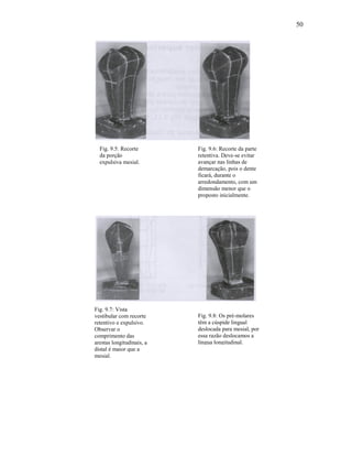 50




  Fig. 9.5: Recorte        Fig. 9.6: Recorte da parte
  da porção                retentiva. Deve-se evitar
  expulsiva mesial.        avançar nas linhas de
                           demarcação, pois o dente
                           ficará, durante o
                           arredondamento, com um
                           dimensão menor que o
                           proposto inicialmente.




Fig. 9.7: Vista
vestibular com recorte     Fig. 9.8: Os pré-molares
retentivo e expulsivo.     têm a cúspide lingual
Observar o                 deslocada para mesial, por
comprimento das            essa razão deslocamos a
arestas longitudinais, a   língua longitudinal.
distal é maior que a
mesial.
 