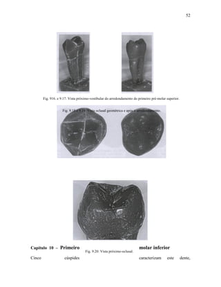 52




        Fig. 916. e 9.17: Vista próximo-vestibular do arredondamento do primeiro pré-molar superior.


                     Fig. 9.18 e 9.19: Vista oclusal geométrica e após o arredondamento.




Capítulo 10 – Primeiro                                                   molar inferior
                                    Fig. 9.20: Vista próximo-oclusal.
Cinco                 cúspides                                           caracterizam      este        dente,
 