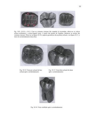 55




Fig. 10.9, 10.10, e 10.11: Com as vertentes externas das cúspides já recortadas, obteve-se os sulcos
ocluso-vestibulares e ocluso-lingual (seta). A partir das pontas de cúspides, demarcar as arestas das
vertentes internar. Observar na figura 10.10 o aspecto geométrico da escultura oclusal, e na figura 10.11, o
início do arredondamento dessa face.




         Fig. 10.12: Vista por oclusal da face          Fig. 10.13: Vista disto-oclusal do dente
         oclusal após o arredondamento.                 após o arredondamento.




                           Fig. 10.14: Vista vestibular após o arredondamento.
 