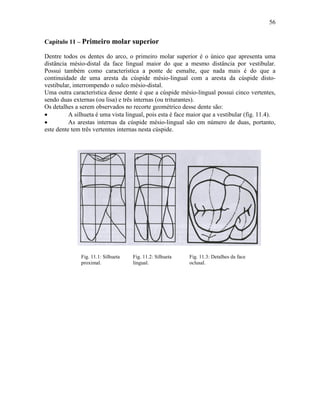 56


Capítulo 11 – Primeiro molar superior

Dentre todos os dentes do arco, o primeiro molar superior é o único que apresenta uma
distância mésio-distal da face lingual maior do que a mesmo distância por vestibular.
Possui também como característica a ponte de esmalte, que nada mais é do que a
continuidade de uma aresta da cúspide mésio-lingual com a aresta da cúspide disto-
vestibular, interrompendo o sulco mésio-distal.
Uma outra característica desse dente é que a cúspide mésio-lingual possui cinco vertentes,
sendo duas externas (ou lisa) e três internas (ou triturantes).
Os detalhes a serem observados no recorte geométrico desse dente são:
•         A silhueta é uma vista lingual, pois esta é face maior que a vestibular (fig. 11.4).
•         As arestas internas da cúspide mésio-lingual são em número de duas, portanto,
este dente tem três vertentes internas nesta cúspide.




              Fig. 11.1: Silhueta   Fig. 11.2: Silhueta   Fig. 11.3: Detalhes da face
              proximal.             lingual.              oclusal.
 