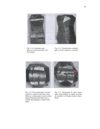 57




  Fig. 11.4: A projeção neste             Fig. 11.5: Vista próximo-vestibular
  dente, no recorte proximal, é da        após o recorte expulsivo e retentivo.
  face lingual.




Fig. 11.6: Vista oclusal após o recorte   Fig. 11.7: Demarcação do sulco mésio-
expulsivo e retentivo das faces axiais.   distal (interrompido na região da ponte
Observar a demarcação do sulco ocluso-    de esmalte) e as fóssulas mesial (seta) e
lingual deslocado para distal, pois a     distal.
cúspide disto-lingual é a menor neste
dente.
 