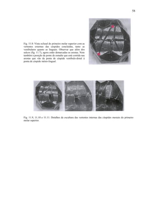58




Fig. 11.8: Vista oclusal do primeiro molar superior com as
vertentes externas das cúspides concluídas, tanto as
vestibulares quanto as linguais. Observar que além dos
sulcos (fig. 11.7), agora estão demarcadas as arestas. Note
também a posição da ponte de esmalte que está contida nas
arestas que vão da ponta de cúspide vestíbulo-distal à
ponta de cúspide mésio-lingual.




Fig. 11.9, 11.10 e 11.11: Detalhes da escultura das vertentes internas das cúspides mesiais do primeiro
molar superior.
 
