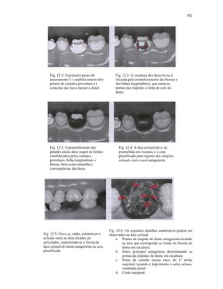 61




    Fig. 12.1: O primeiro passo do              Fig. 12.2: A escultura das faces livres é
    enceramento é i estabelecimento dos         iniciada pelo estabelecimento das bossas e
    pontos de contatos proximais e i            das linhas longitudinais, que unem as
    contorno das faces mesial e distal.         pontas das cúspides à linha de colo do
                                                dente.




    Fig. 12.3: O preenchimento das                Fig. 12.4: A face oclusal deve ser
    paredes axiais deve seguir os limites         preenchida em excesso, e a cera
    estabelecidos pelos contatos                  plastificada para registro das relações
    proximais, linha longitudinais e              oclusais com o arco antagonista.
    bossas, bem como tamanho e
    convergências das faces.




                                            Fig. 12.6: Os seguintes detalhes anatômicos podem ser
Fig. 12.5: Deve-se, então, estabelecer a    observados na face oclusal.
oclusão entre as duas arcadas do                 a. Pontas de cúspide do dente antagonista tocando
articulador, imprimindo-se a forma da                na área que corresponde ao fundo de fóssula do
face oclusal do dente antagonista na cera            dente em escultura.
plastificada.                                    b. Sulco principal antagonista determinando as
                                                     pontas de cúspides do dente em escultura.
                                                 c. Ponte de esmalte (nesse caso, do 1º molar
                                                     superior) tocando e imprimindo o sulco ocluso-
                                                     vestibular distal.
                                                 d. Crista marginal.
 