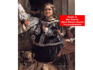 Detalle da
Mari Bárbola
(María Bárbara Asquín)
Ten acondroplasia
 