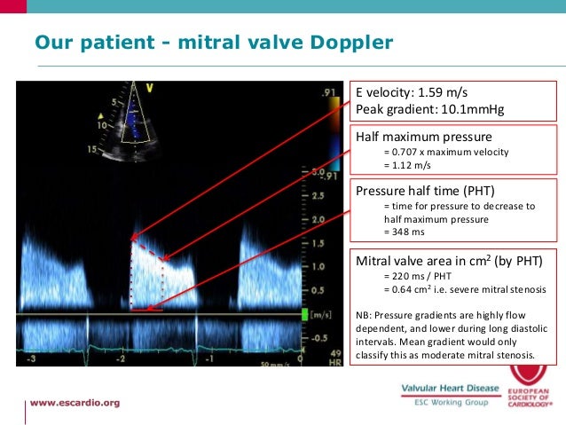 Shortness of breath in a 51 year old woman