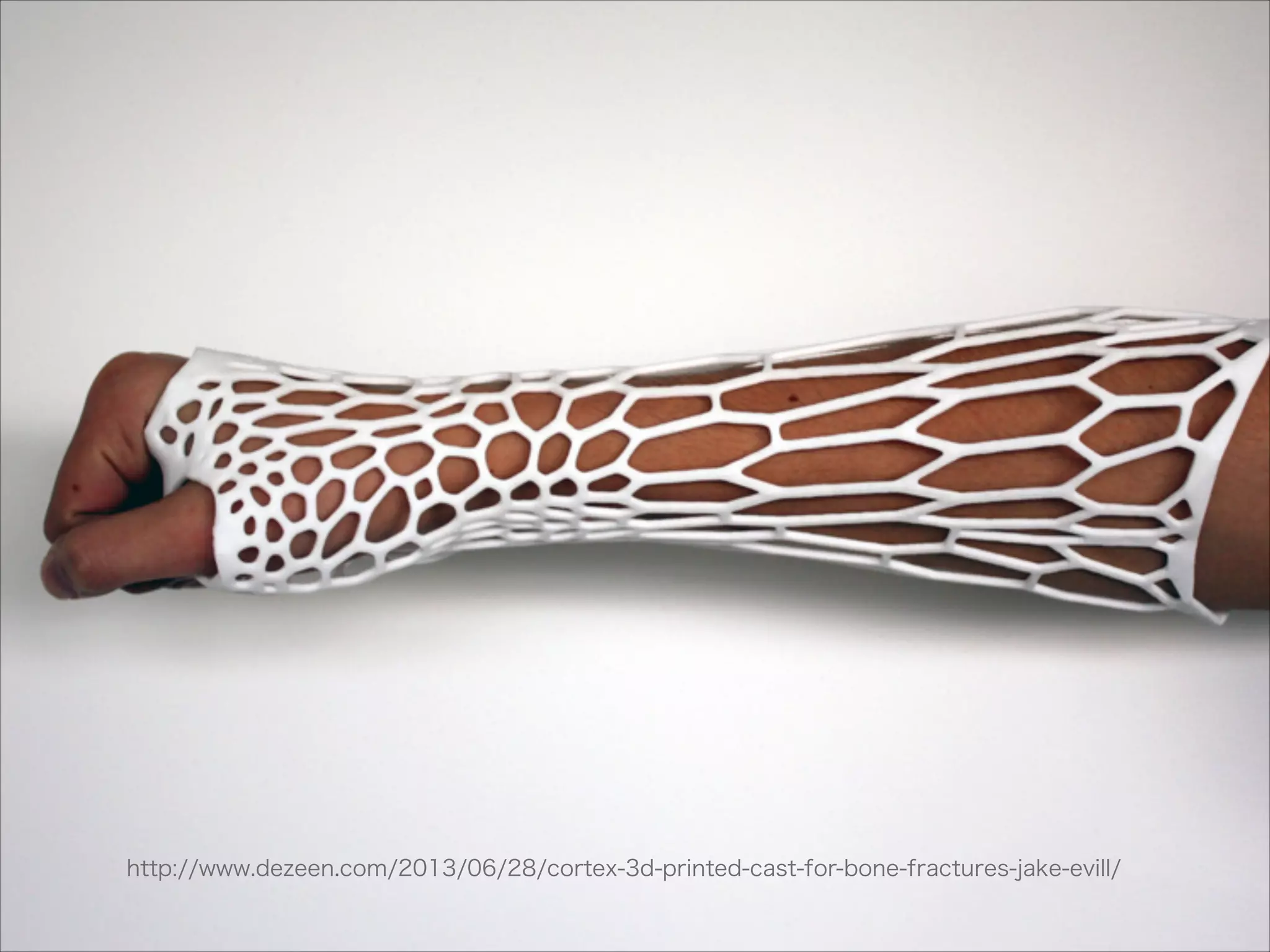 http://www.dezeen.com/2013/06/28/cortex-3d-printed-cast-for-bone-fractures-jake-evill/

 