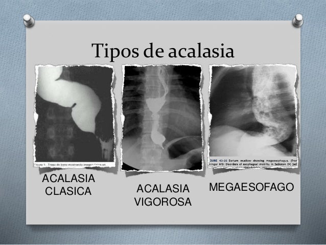 Cirugia Esófago patologías benignas