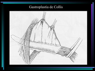 esofago cirugia general de la universidad .ppt