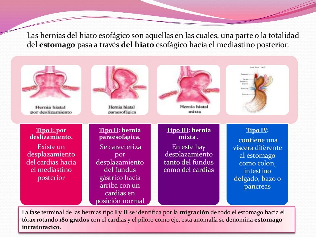 Esófago, hernia hiatal, y acalasia
