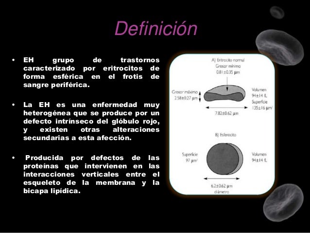 Esferocitosis hereditaria
