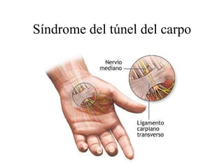 Síndrome del túnel del carpo 
