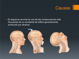 Causas
 El esguince cervical es una de las consecuencias más
frecuentes de un accidente de tráfico generalmente
producido por alcance.
 