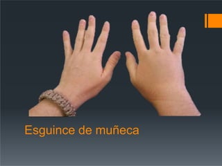 Esguince de muñeca
 