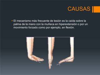 CAUSAS
 El mecanismo más frecuente de lesión es la caída sobre la
palma de la mano con la muñeca en hiperextensión o por un
movimiento forzado como por ejemplo, en flexión.
 