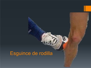 Esguince de rodilla
 