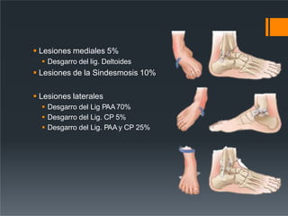  Lesiones mediales 5%
 Desgarro del lig. Deltoides
 Lesiones de la Sindesmosis 10%
 Lesiones laterales
 Desgarro del Lig PAA 70%
 Desgarro del Lig. CP 5%
 Desgarro del Lig. PAA y CP 25%
 