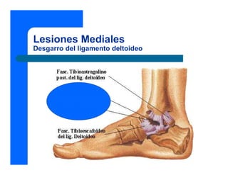 Lesiones Mediales
Desgarro del ligamento deltoideo
 