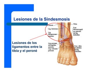 Lesiones de la Sindesmosis




Lesiones de los
ligamentos entre la
tibia y el peroné
 