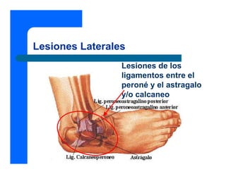 Lesiones Laterales
                 Lesiones de los
                 ligamentos entre el
                 peroné y el astragalo
                 y/o calcaneo
 