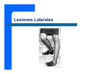 Lesiones Laterales
 