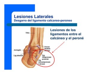 Lesiones Laterales
Desgarro del ligamento calcaneo-peroneo


                        Lesiones de los
                        ligamentos entre el
                        calcáneo y el peroné
 