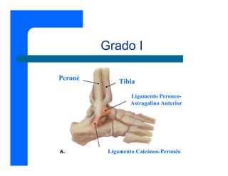 Grado I

Peroné        Tibia

                  Ligamento Peroneo-
                  Astragalino Anterior




          Ligamento Calcáneo-Peronéo
 