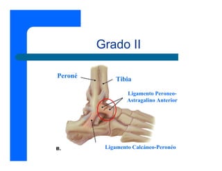 Grado II

Peroné        Tibia

                  Ligamento Peroneo-
                  Astragalino Anterior




          Ligamento Calcáneo-Peronéo
 