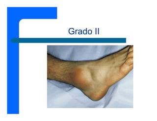 Grado II
 