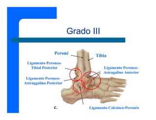 Grado III

                 Peroné           Tibia
 Ligamento Peroneo-
   Tibial Posterior                   Ligamento Peroneo-
                                      Astragalino Anterior
 Ligamento Peroneo-
Astraqgalino Posterior




                               Ligamento Calcáneo-Peronéo
 