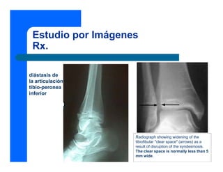 Estudio por Imágenes
 Rx.

diástasis de
la articulación
tibio-peronea
inferior




                    Radiograph showing widening of the
                    tibiofibular "clear space" (arrows) as a
                    result of disruption of the syndesmosis.
                    The clear space is normally less than 5
                    mm wide.
 